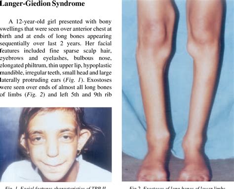 What Is Langer Giedion Syndrome Symptoms