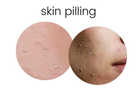 Understanding Skin Pilling: Causes, Prevention, and Solutions