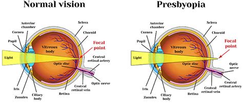 What Is Presbyopia