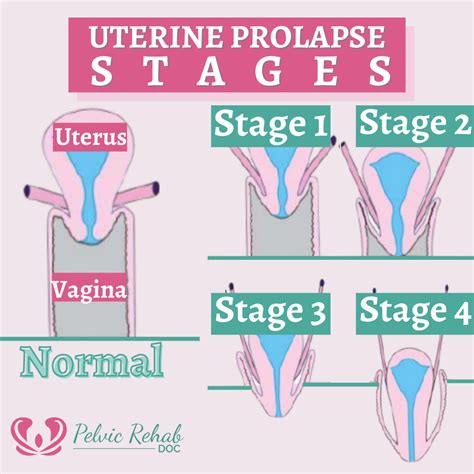 What Is Prolapse Meaning