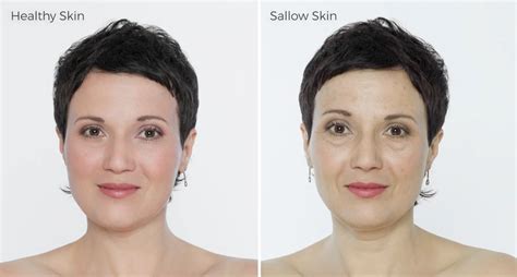 Revive Your Glow: Understanding the Causes and Solutions for Sallow Skin