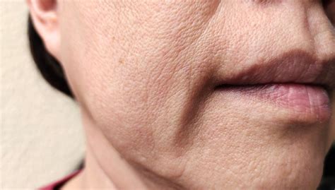 Understanding Skin Laxity: Causes, Treatments and Prevention