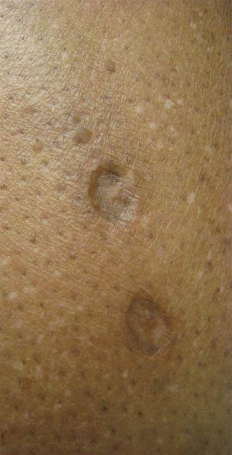 Uncovering the Dangers of Skin Popping: Protecting Your Health and Future