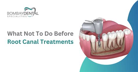 What Not To Do Before A Root Canal