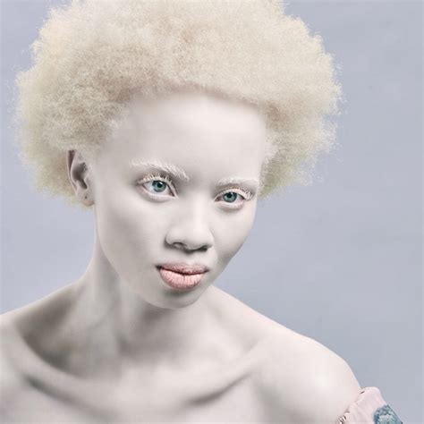 What is Albino