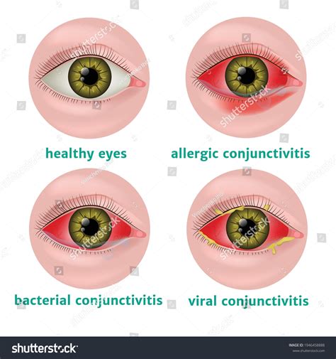 What is Conjunctivitis Anyway?