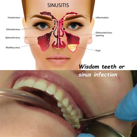 What to Do If You Suspect Wisdom Teeth Are Causing Sinus Problems