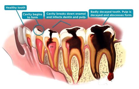 What to Do When a Decayed Tooth Causes Headaches
