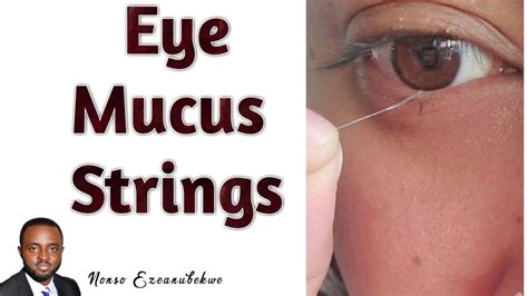 When Does White String From Eye Signal a Serious Problem?