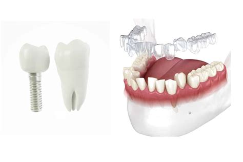 When Invisalign and Implants Can Work Together