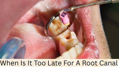 When Is It Too Late For A Root Canal
