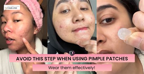 When Not to Use a Pimple Patch