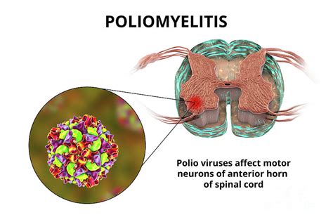 When Polio Attacks the Nervous System