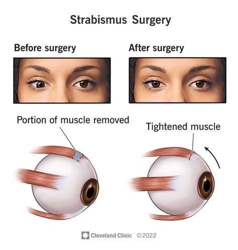 When Surgery is Necessary Strabismus correction