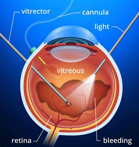 When Surgery is Needed: The Vitrectomy