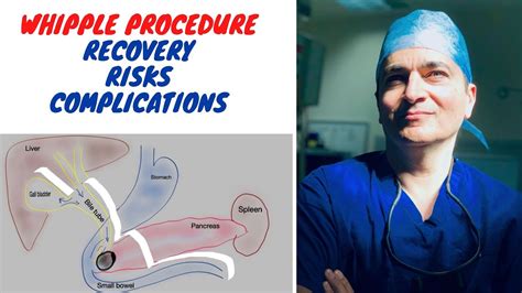 Whipple Procedure: Recovery, Risks & What to Expect.