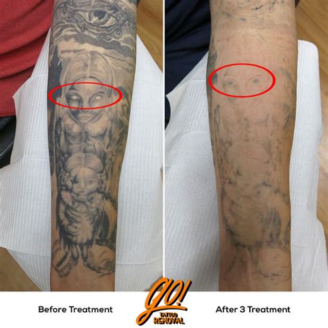 White Ink & PicoSure Laser Tattoo Removal AustinPicoSure