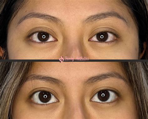 Who Should Consider Using Eye Lifting Drops?