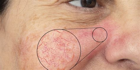 Why Do Broken Capillaries Under Eye Appear
