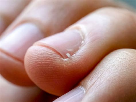 Why Do I Keep Getting Hangnails