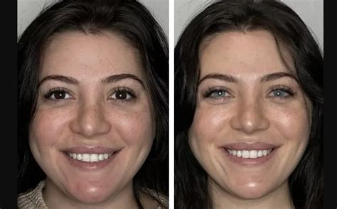 Why Do People Choose Blue Eye Surgery