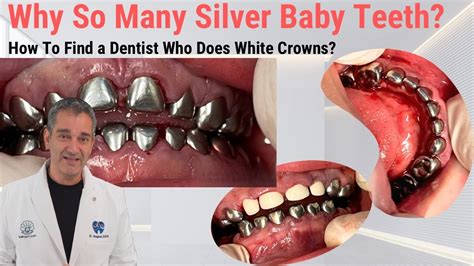 Unlocking the Reason Behind Silver Teeth: Discover the Heartwarming Stories and Emotional Journeys