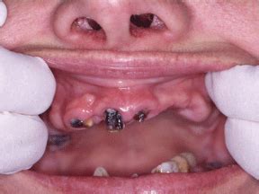 Why Does Meth Ruin Teeth