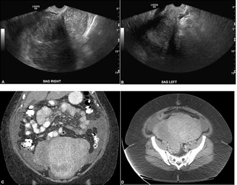 Why Is My Left Ovary Not Visible On Ultrasound