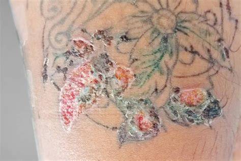 Why Is My Tattoo So Itchy