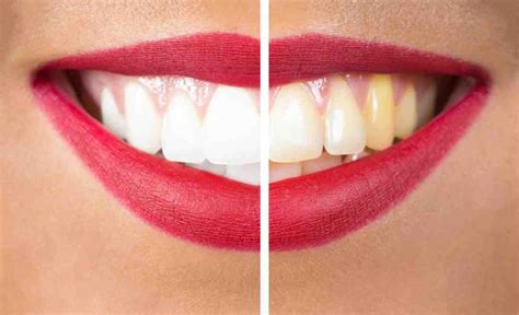 Why Wont My Teeth Whiten