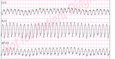 Tachycardia Rhythm Strip