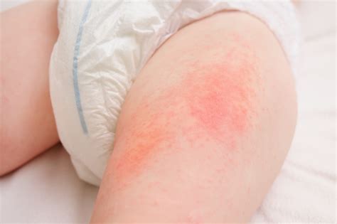 Windeldermatitis Bilder
