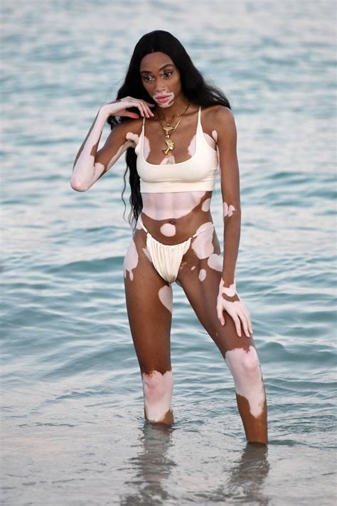 Overcoming Beauty Standards: The Inspiring Story of Winnie Harlow and Her Triumph Against Skin Condition
