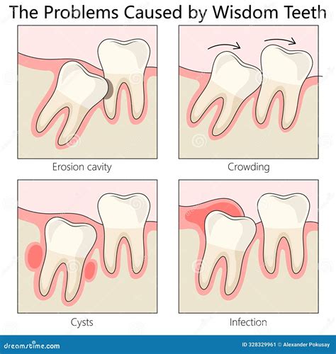 Wisdom Teeth: Problems & Effective Solutions