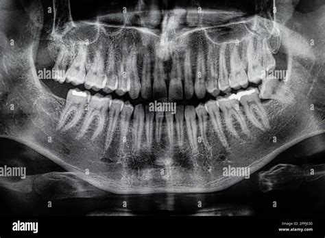 Wisdom Teeth Image