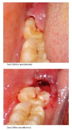 Unravelling the Mysteries of Wisdom Teeth Flap: A Comprehensive Guide to Skin Flapping