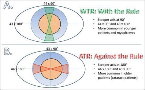 With-the-Rule Astigmatism