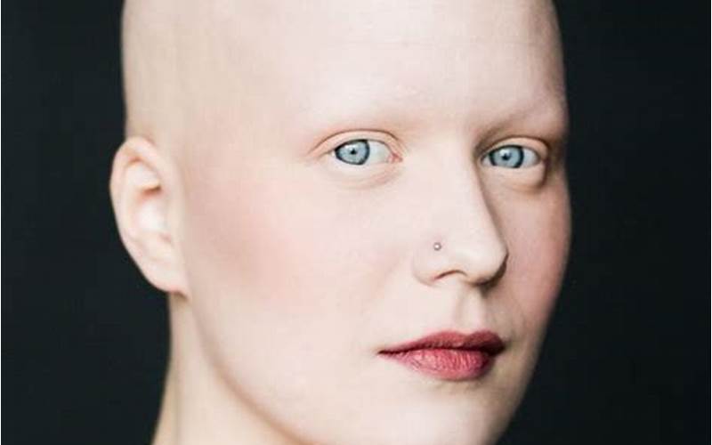 Woman With Alopecia