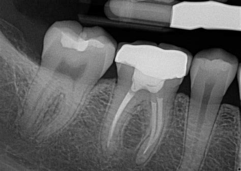 X Ray Of Tooth That Needs Root Canal