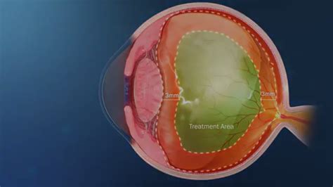 Diving Deep into Eye Floaters Treatment Laser (YAG Vitreolysis Explained)