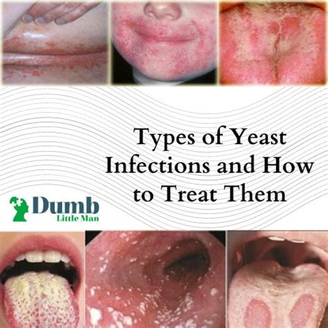 Yeast Infection Bumps Causes, Symptoms, Treatment & Cure.