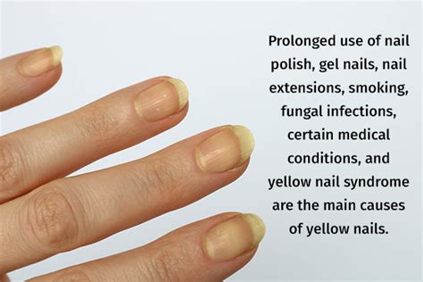 Yellow Nails: Causes & Effective Treatments