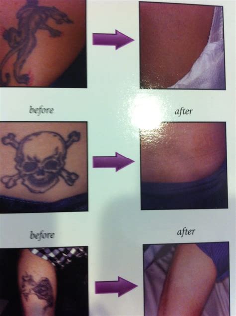 Tattoo Removal San Diego Yelp