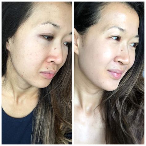 Zo Skin Health Before And After