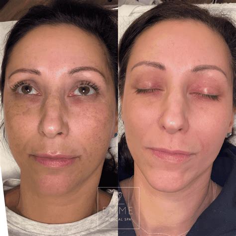 Discover the Astonishing Transformations: Zo Skin Before and After Journey