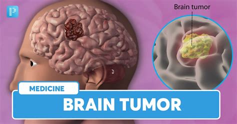 a brain tumour
