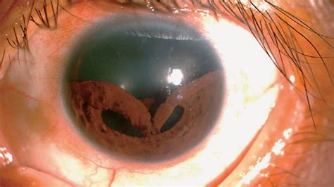 a collapsed iris