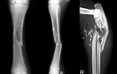 a splintered or crushed bone