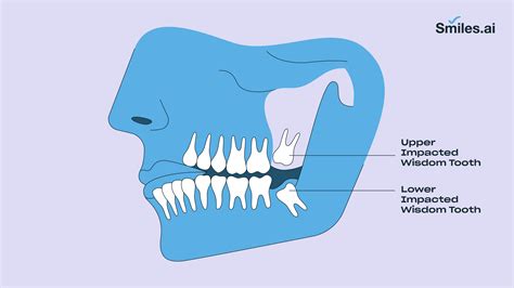 a wisdom tooth