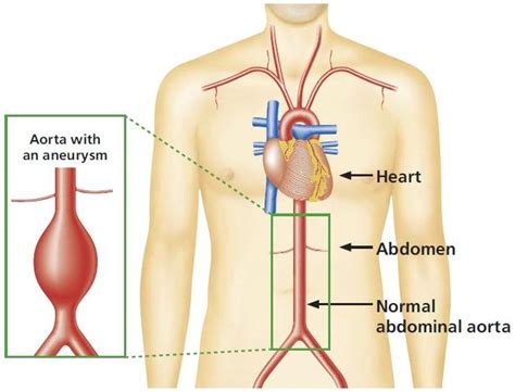 Protect Your Heart: The Importance of AAA Aortic Screening for Early Detection